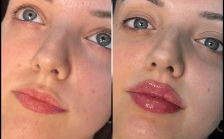 Best Doctors in dubai for Fillers Achieve the Look You Desire