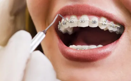 Orthodontic Treatment In Dallas- Your Complete Guide To A Confident Smile