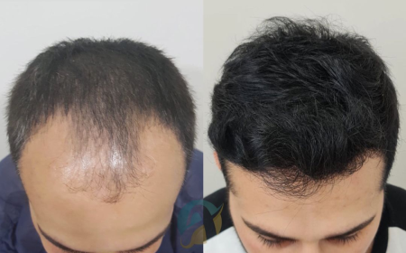 Hair Transplant in Islamabad: Achieve Full and Natural Hair