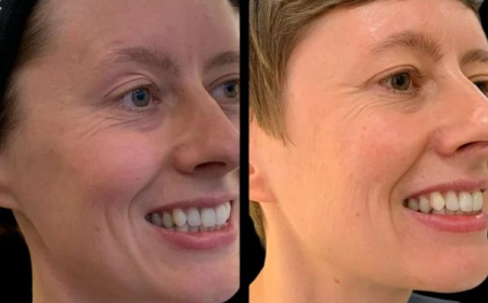 How Often Is Profhilo Done at the Best Aesthetic Clinic in Dubai?