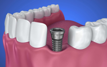 Dental Implants in Springtown: Procedure, Benefits, and Cost