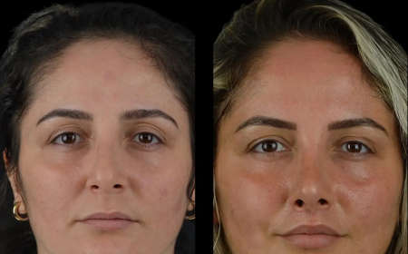 Cheek Fillers in Dubai When to Schedule a Review