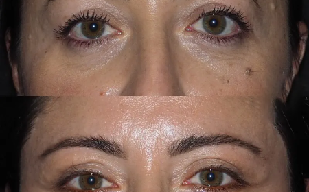 Eye Bag Removal Post-Care Tips from Best Doctors in Dubai