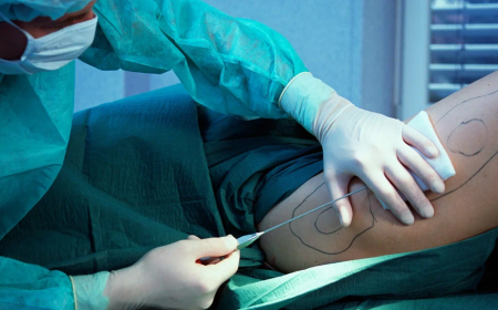 How Much Does Liposuction Cost? Factors That Affect Liposuction