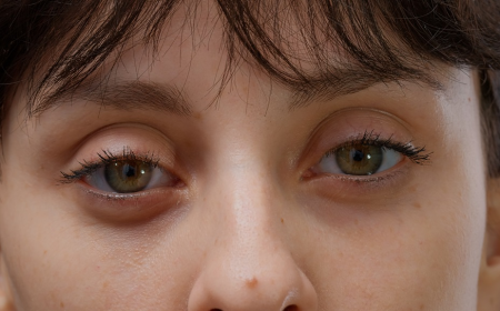 Recovery Timeline After Eyelid Bag Surgery Dubai