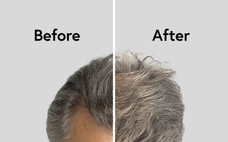 Regain Your Hair Confidence with PRP Therapy in Islamabad