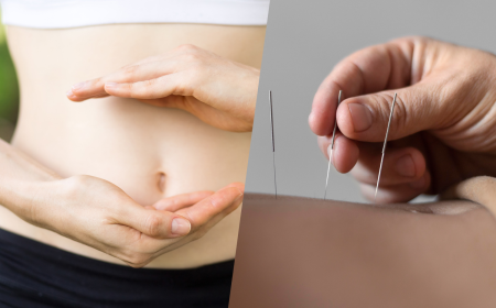 Can Acupuncture Help You Lose Weight Without Extreme Diets?