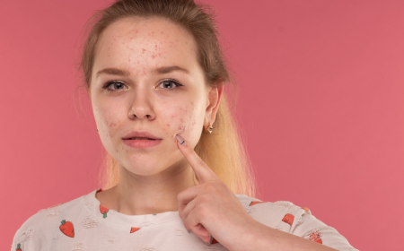 Why Do Pimples Appear on the Forehead? Understanding Forehead Acne 