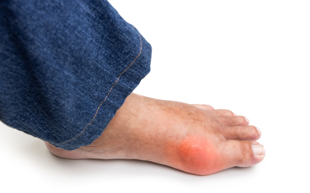 Does Gout Run in Families? What Science Says