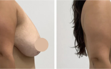 Redefine Shape with Breast Lift in Dubai