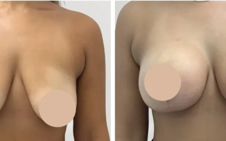 Discover Confidence Again with Breast Reduction in Dubai