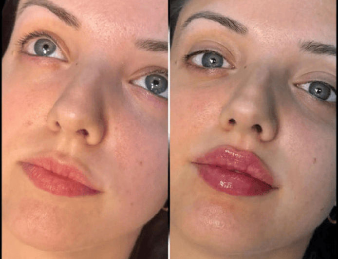 Best Doctors in dubai for Fillers Achieve the Look You Desire