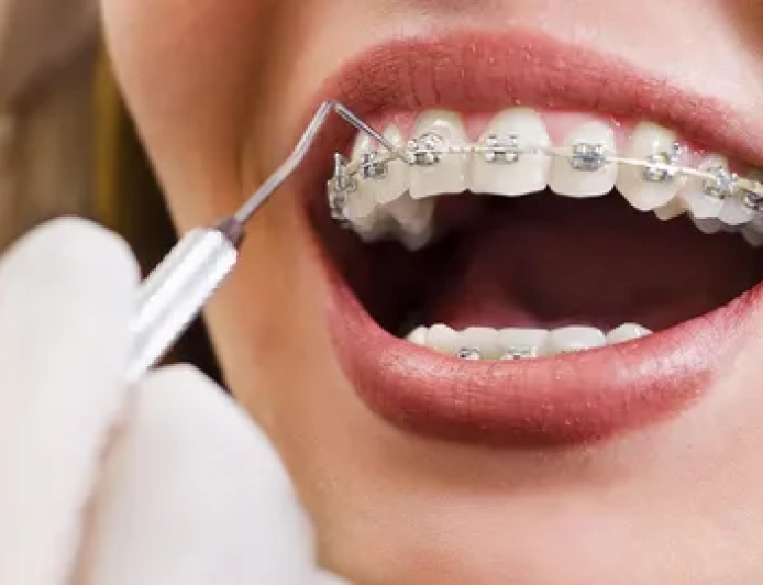 Orthodontic Treatment In Dallas- Your Complete Guide To A Confident Smile