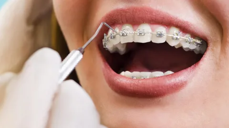 Orthodontic Treatment In Dallas- Your Complete Guide To A Confident Smile