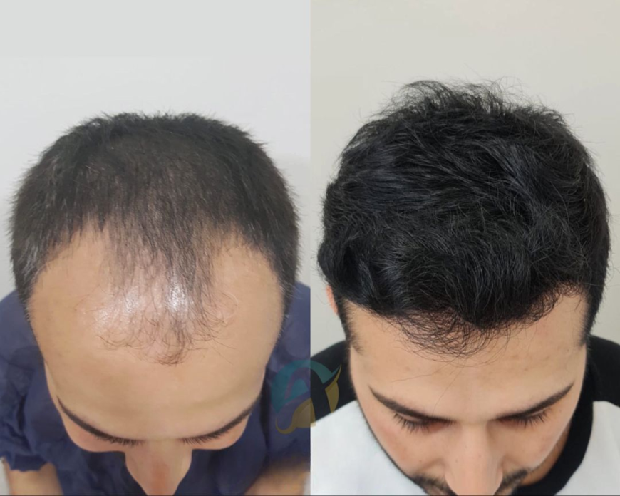 Hair Transplant in Islamabad: Achieve Full and Natural Hair