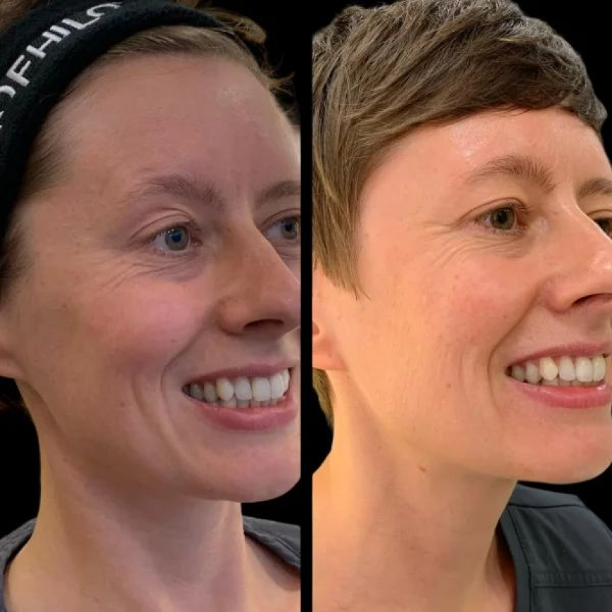 How Often Is Profhilo Done at the Best Aesthetic Clinic in Dubai?