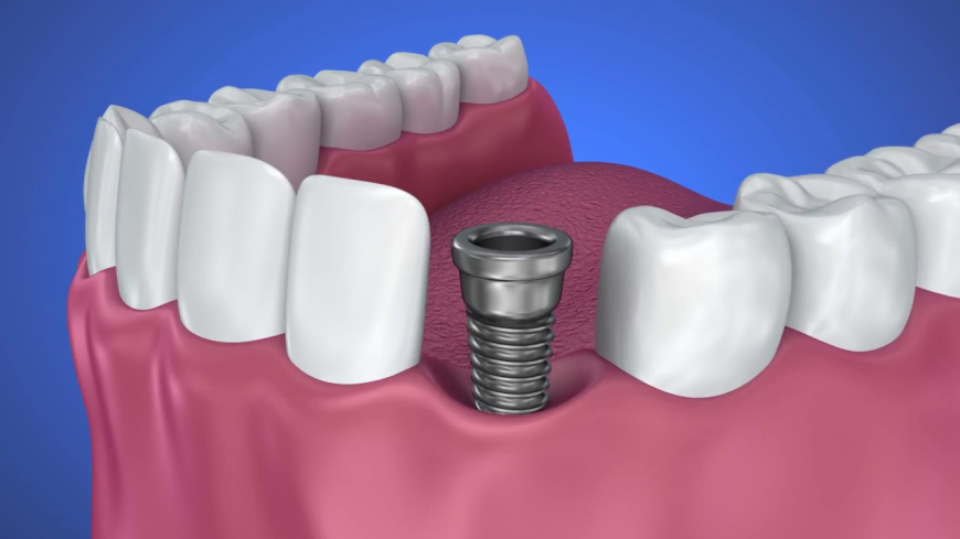 Dental Implants in Springtown: Procedure, Benefits, and Cost
