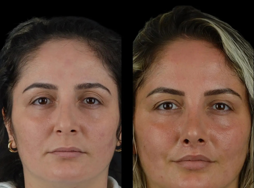 Cheek Fillers in Dubai When to Schedule a Review