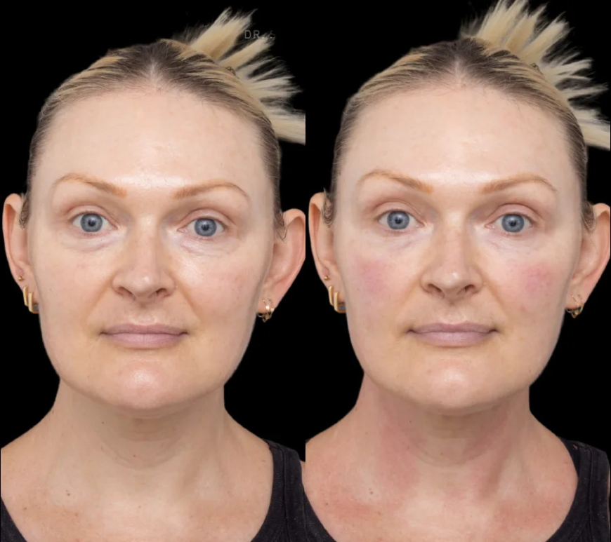 How to Protect Your Skin After Getting Under Eye Fillers in Dubai
