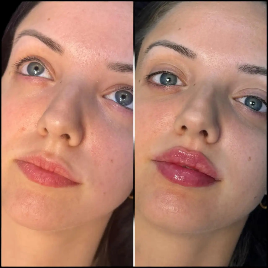 Fillers in Dubai Procedure Step-by-Step
