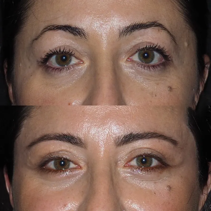 Eye Bag Removal Post-Care Tips from Best Doctors in Dubai
