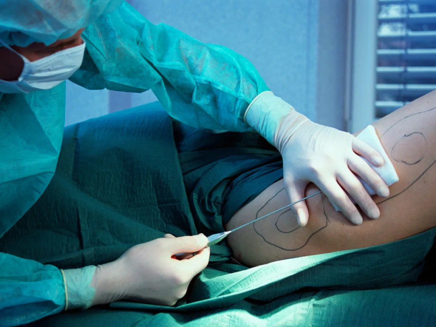 How Much Does Liposuction Cost? Factors That Affect Liposuction