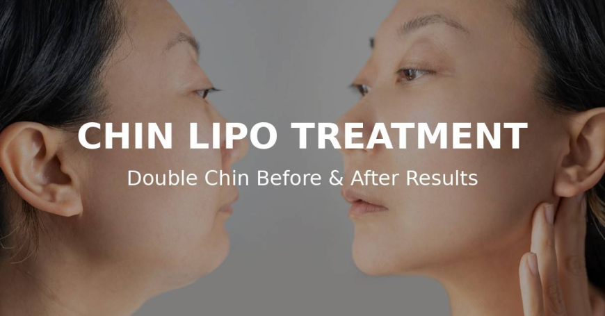 Sleek & Sharp Look: Chin Lipo Treatment in Islamabad
