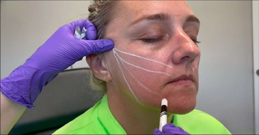 Look Stunning Today: Thread Lift Islamabad