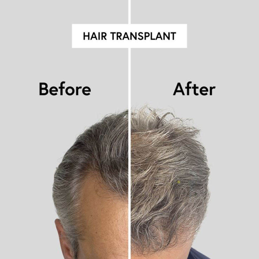 Regain Your Hair Confidence with PRP Therapy in Islamabad