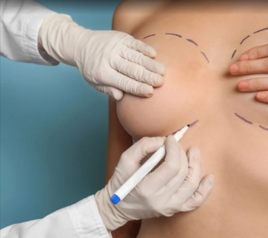 Mia Breast Implant In Dubai – Myths vs. Facts Explained