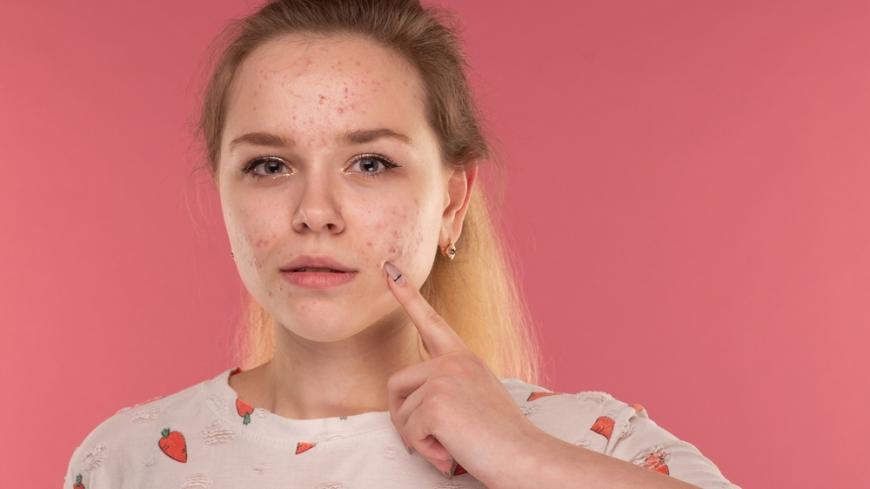 Why Do Pimples Appear on the Forehead? Understanding Forehead Acne 