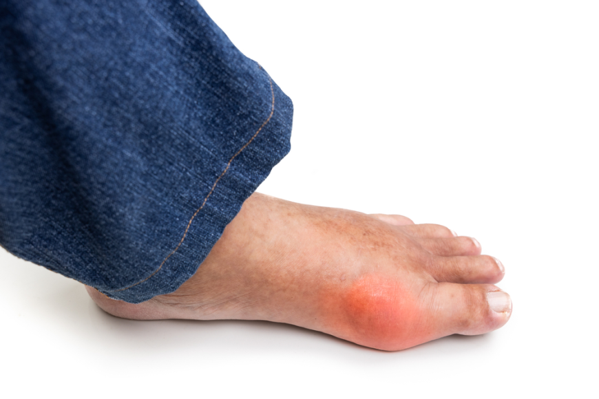 Does Gout Run in Families? What Science Says
