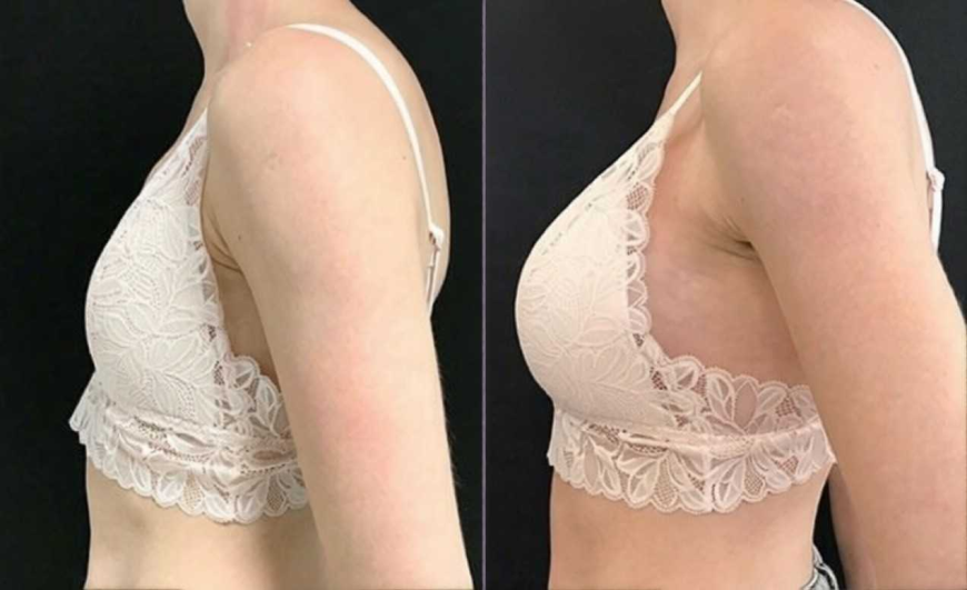 Complete Breast Enlargement Injections in Islamabad