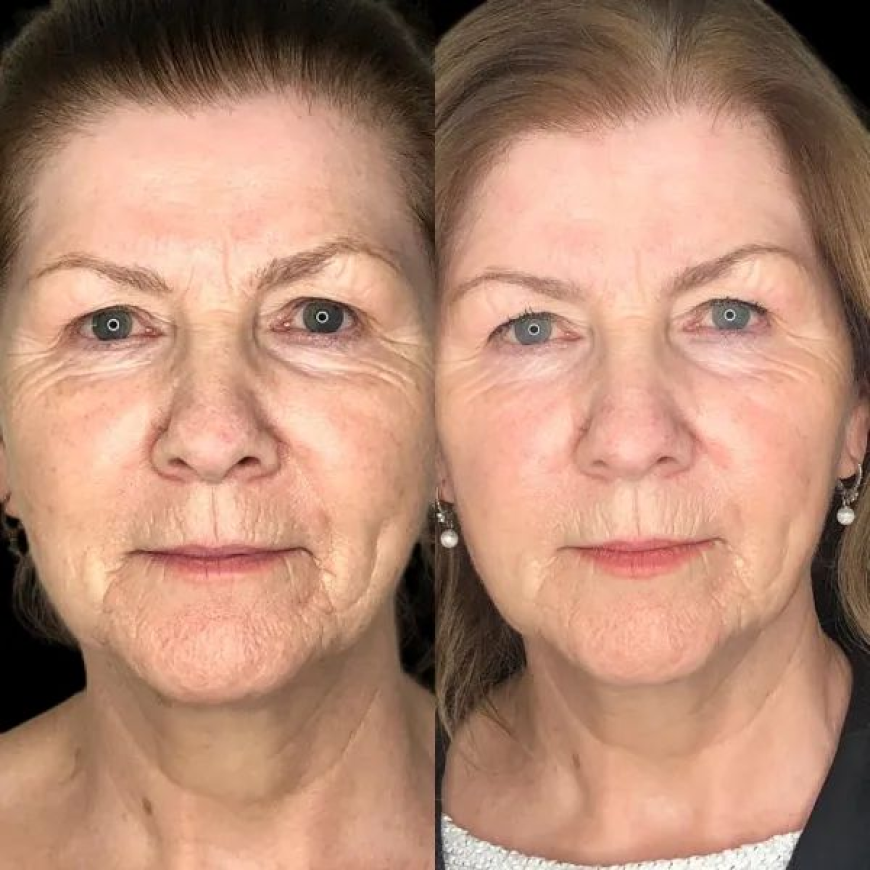 How Does the Best Aesthetic Clinic in Dubai Enhance Results with Profhilo?