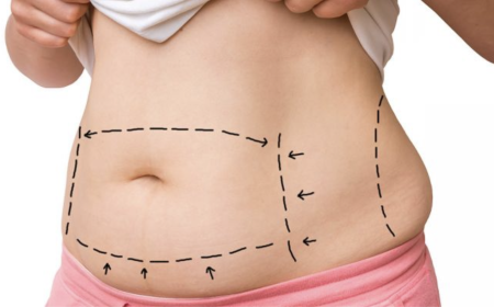 Bariatric Surgery in Islamabad: What Patients Should Expect