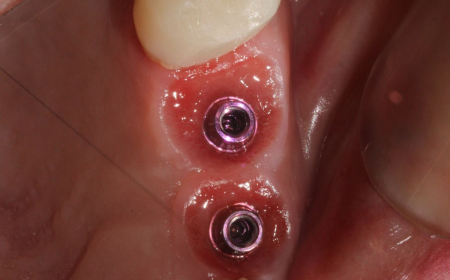 Implantes de Carga Inmediata en Barcelona Sonrisa Nueva en un Día