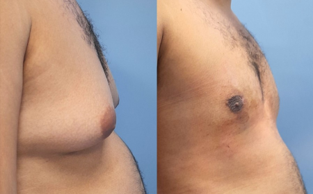 men breast tissue removal