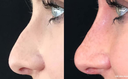 Insights on Finding the Best Rhinoplasty Surgeon in Dubai