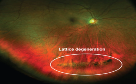 Lattice Retinal Degeneration and Why Monitoring Is Important