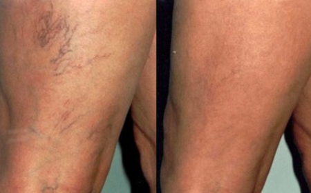 Spider Vein Removal Before and After: What Results Can You Expect?