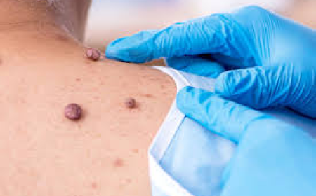 Mole Removal in Dubai: Procedures, Healing & Expert Care | Tajmeels Clinic