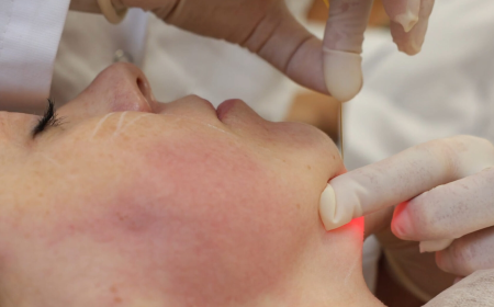Is Endolift Treatment in Dubai the Ultimate Fix for Sagging Skin