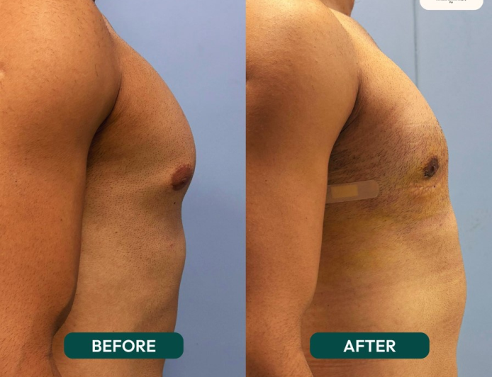 Gynecomastia Surgery Islamabad – Complete Guide to Treatment, Cost, and Results