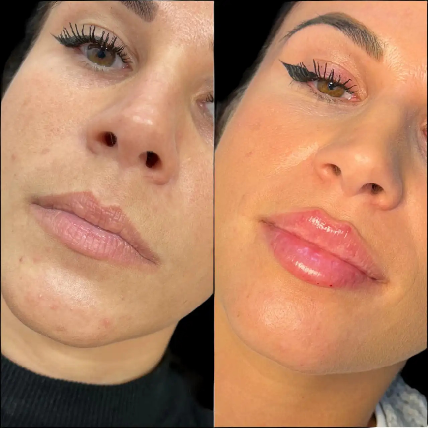 Top Choice For Best Aesthetic Clinics in Dubai for Dermal Fillers
