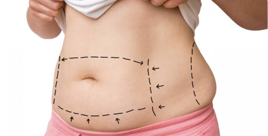 Bariatric Surgery in Islamabad: What Patients Should Expect