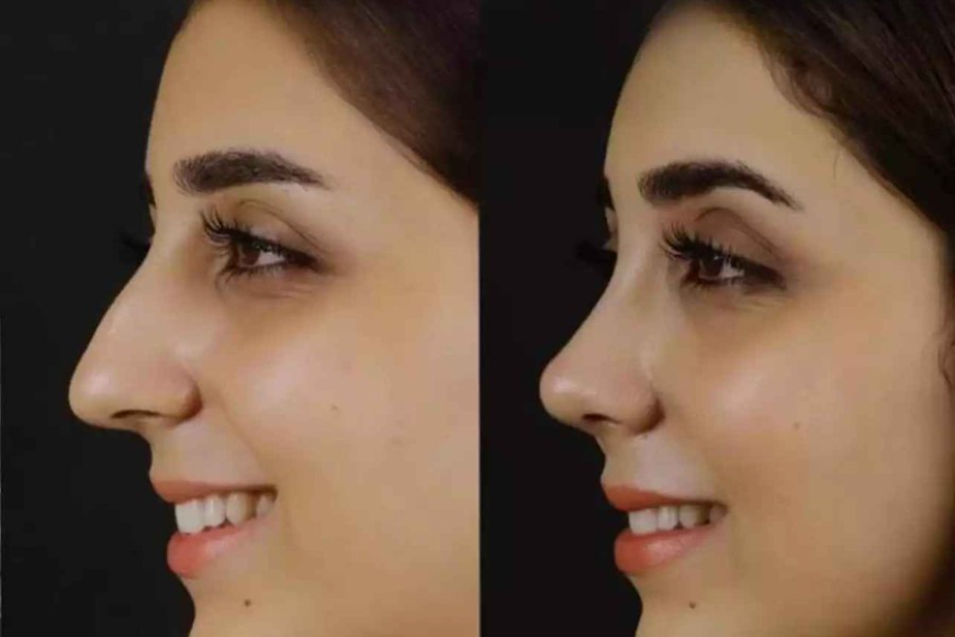 Recovery After Nose Deviated Septum Surgery in Dubai Tips