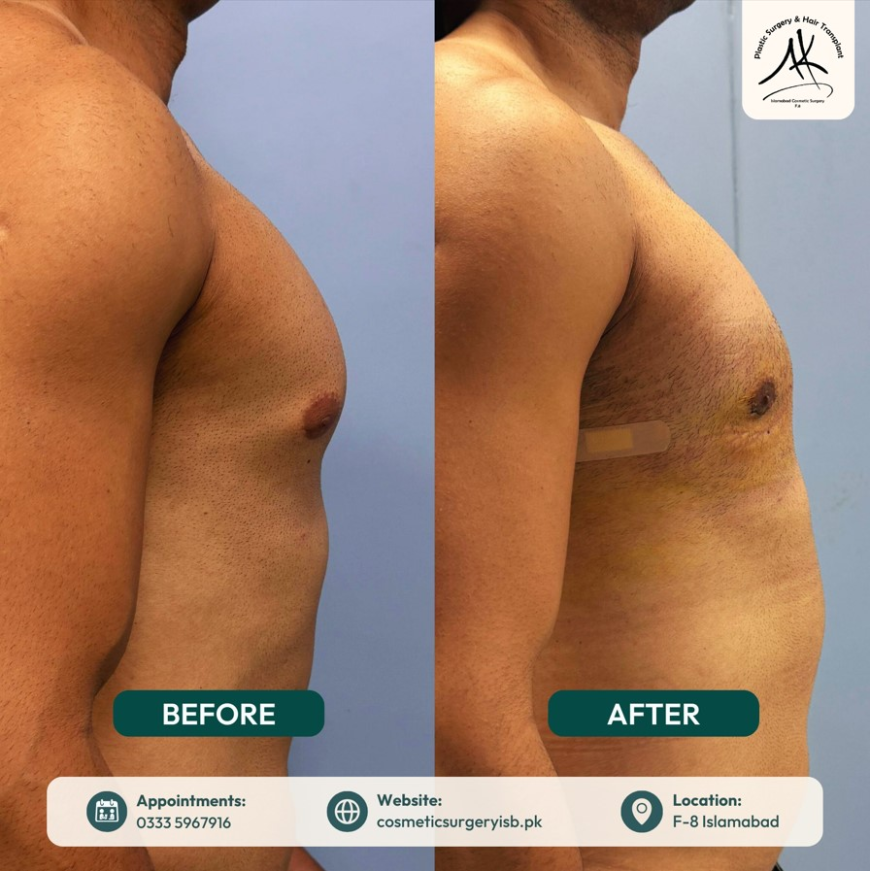 Gynecomastia Surgery Islamabad – Complete Guide to Treatment, Cost, and Results
