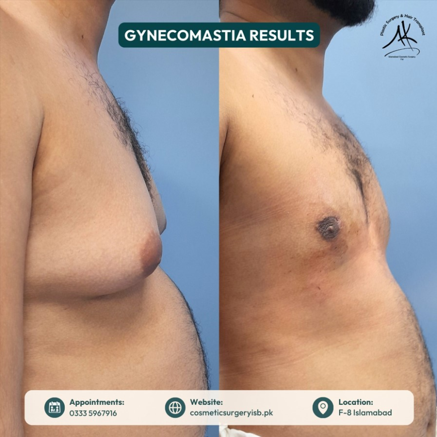men breast tissue removal