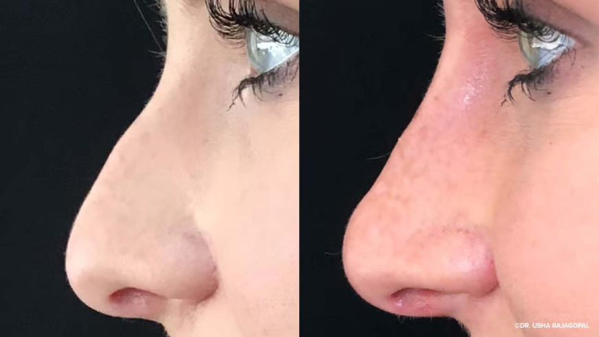 Insights on Finding the Best Rhinoplasty Surgeon in Dubai