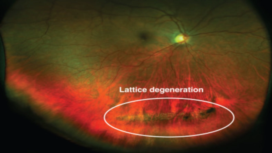 Lattice Retinal Degeneration and Why Monitoring Is Important